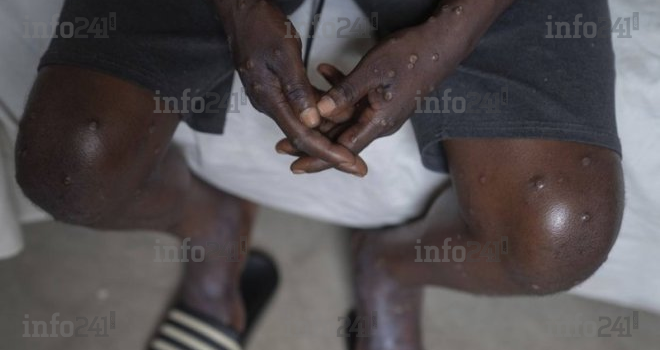 Mpox&nbsp;: Plus de 2 000 nouveaux cas signalés en Afrique en un mois